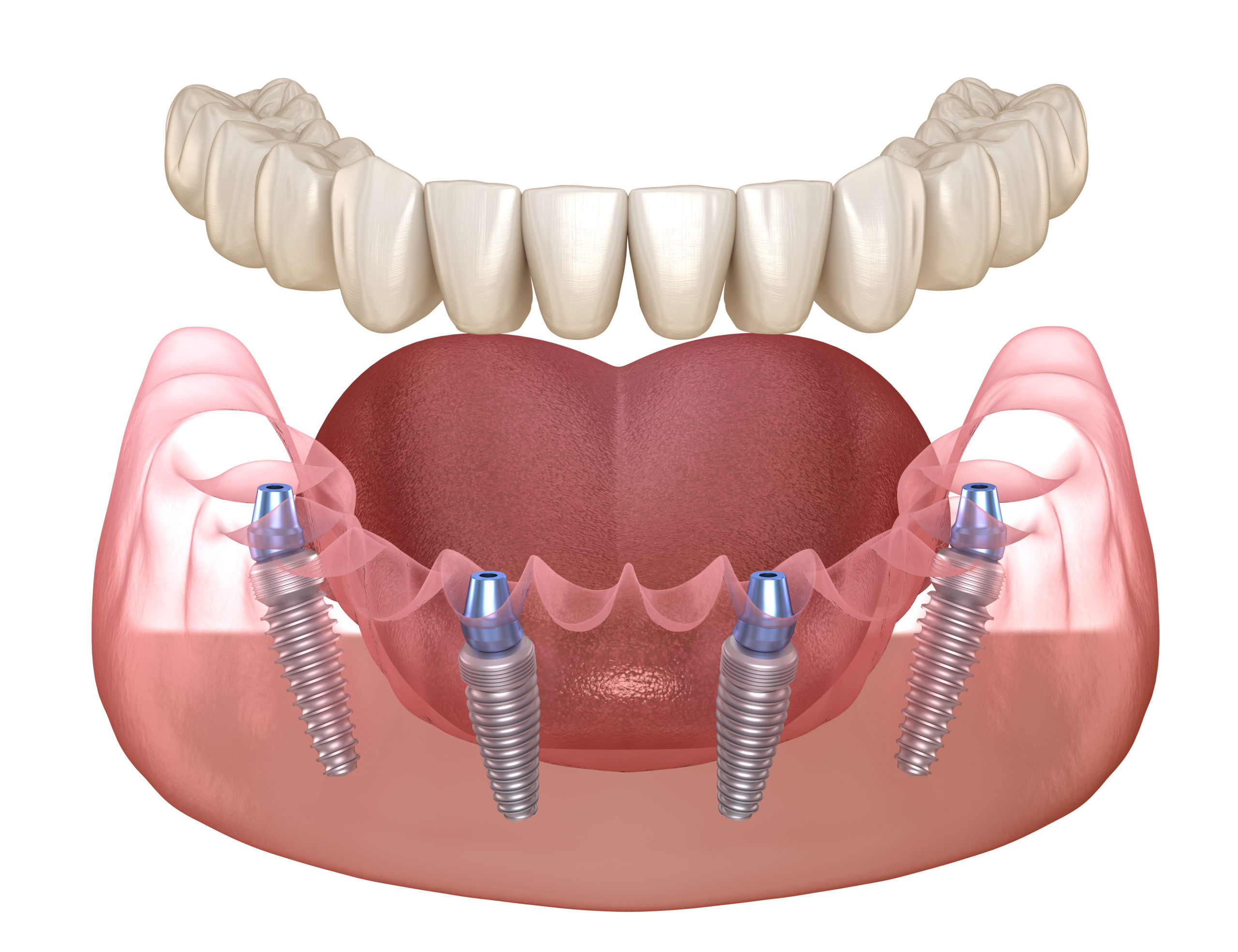 Протез на имплантах при полном отсутствии. Несъёмный зубной протез на 6 имплантах. Имплантация челюсти на 6 имплантах. Имплантация зубов all on 6. Имплантация all-on-6 (имплантация на 6 имплантах).